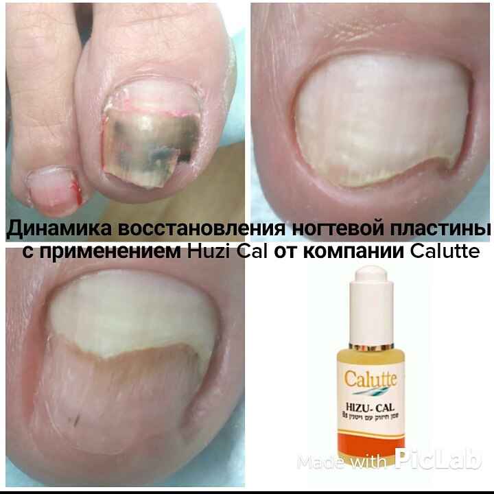 Против онихолизиса. Средство онихолизиса ногтей препараты в аптеке. Онихолизис ногтей средства. Средство от онихализис. Средство для восстановления ногтевой пластины.
